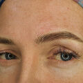18-24 months Top Up – Micropigmentation