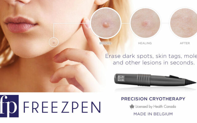 NEW Cryotherapy Freezpen