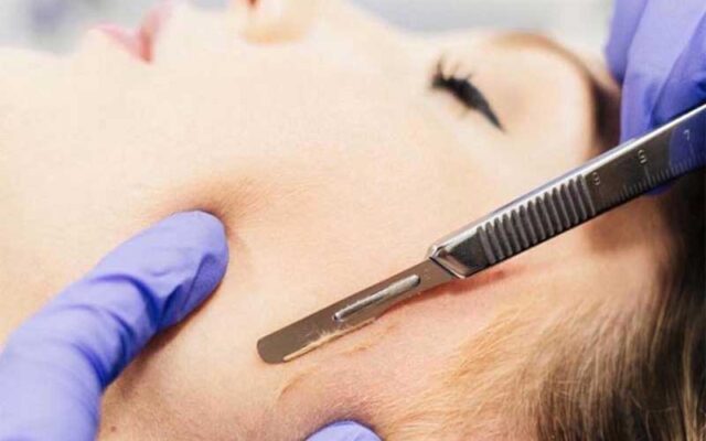 Dermaplaning
